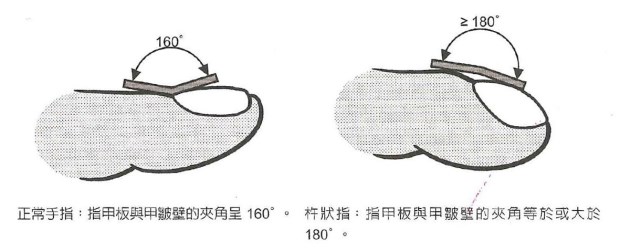 怎樣看出心臟有問題 從手指、舌頭眼神測(cè)試