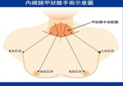 脖子不留疤 從乳暈切除甲狀腺腫瘤