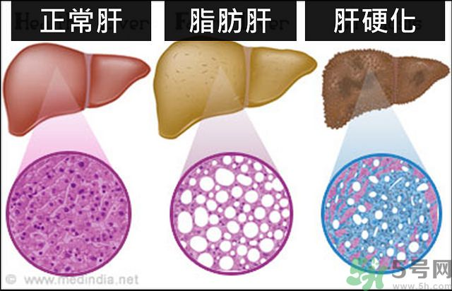 得了脂肪肝該怎么治？脂肪肝對人體危害有多大？