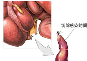 闌尾手術(shù)會影響結(jié)腸嗎？闌尾手術(shù)術(shù)后要注意什么？