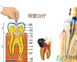 什么是根管治療？為什么牙齒疼要做根管治療？