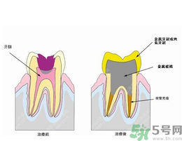 什么是根管治療？為什么牙齒疼要做根管治療？