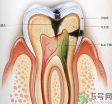 什么是根管治療？為什么牙齒疼要做根管治療？