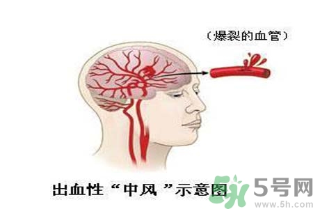 腦中風(fēng)的護理措施？腦中風(fēng)的飲食護理？