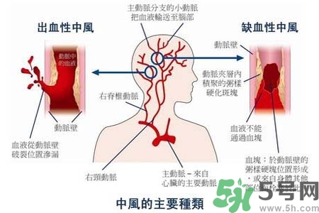 腦中風(fēng)的發(fā)病因素？腦中風(fēng)的并發(fā)癥有哪些 ？