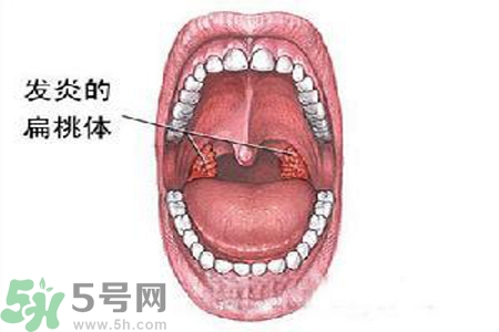 慢性咽炎是什么？慢性咽炎的癥狀有哪些？