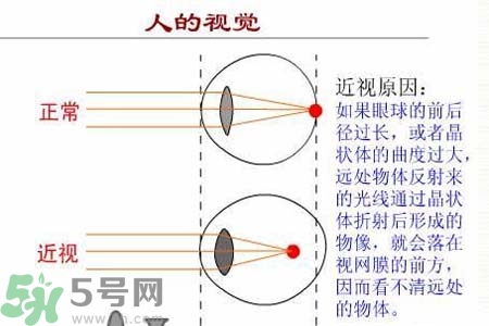 近視眼的發(fā)病因素？近視眼的并發(fā)癥有哪些？