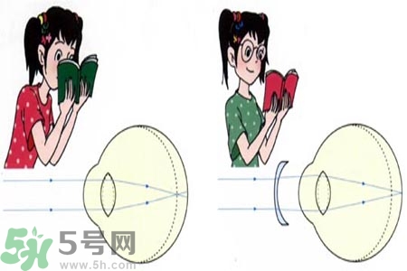 近視眼的發(fā)病因素？近視眼的并發(fā)癥有哪些？