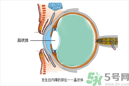 白內(nèi)障的護(hù)理措施是什么？白內(nèi)障的飲食護(hù)理有哪些？