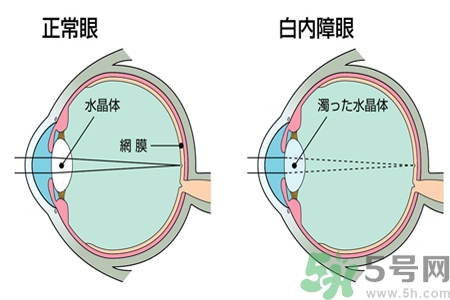 白內(nèi)障的發(fā)病因素是什么？白內(nèi)障并發(fā)癥有哪些？