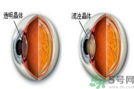 白內(nèi)障治療方法是什么？白內(nèi)障可以用什么藥物治療？