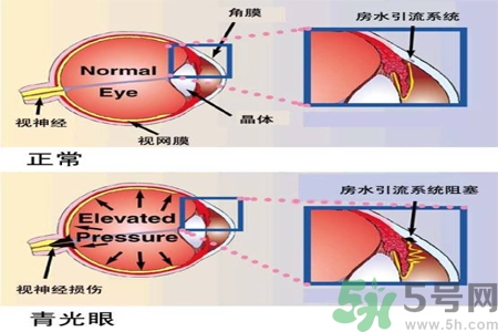 青光眼的護理措施有什么？青光眼的飲食護理有哪些？