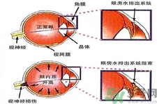 青光眼的發(fā)病因素是什么？青光眼的并發(fā)癥有哪些？