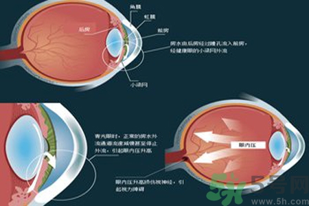 青光眼的高發(fā)人群有哪些？如何預(yù)防青光眼？