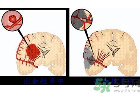 腦出血的發(fā)病因素是什么？腦出血的并發(fā)癥有哪些？