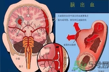 腦出血的發(fā)病因素是什么？腦出血的并發(fā)癥有哪些？