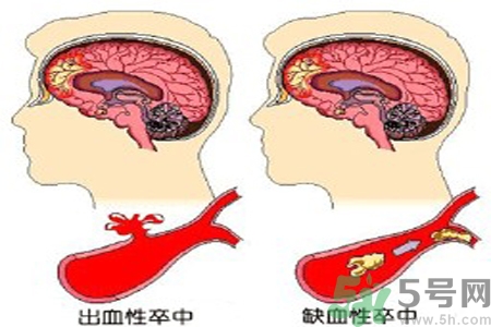 腦出血的治療方法是什么？腦出血可以用哪些藥物治療？