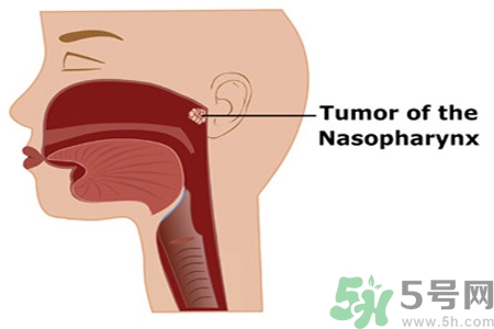 鼻咽癌的日常措施是什么？鼻咽癌注意的飲食有哪些？