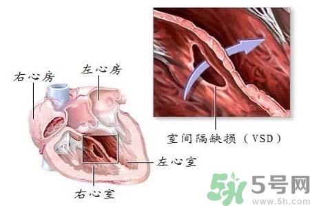 先天性心臟病是什么？先天性心臟病的癥狀有哪些？