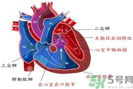 先天性心臟病發(fā)病原因是什么？