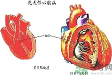 先天性心臟病發(fā)病原因是什么？