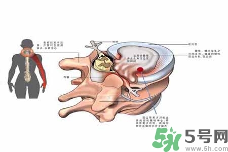 為什么年輕人容易得頸椎??？頸椎病嚴(yán)重的癥狀有哪些？