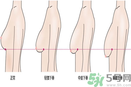 ?女性乳房下垂的原因是什么？女性乳房下垂的分類有哪些？