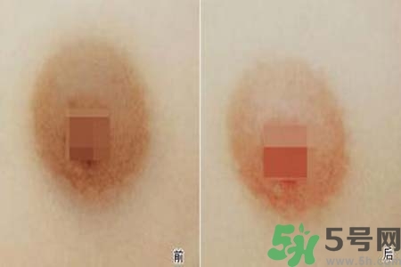 乳頭發(fā)黑怎么辦？怎么樣可以使乳頭變白？