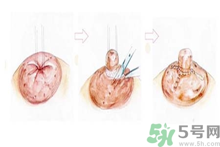 乳頭內陷怎么回事？乳頭內陷的原因是什么？