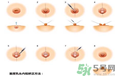 乳頭內陷怎么回事？乳頭內陷的原因是什么？