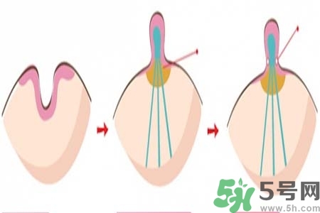 乳頭內(nèi)陷怎么辦？乳頭內(nèi)陷的癥狀有哪些？