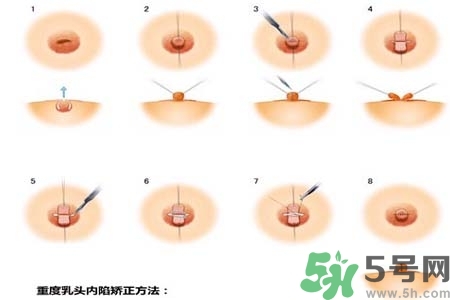 乳頭內(nèi)陷怎么辦？乳頭內(nèi)陷的癥狀有哪些？