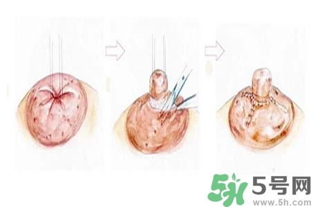 乳頭內(nèi)陷怎么辦？乳頭內(nèi)陷的癥狀有哪些？