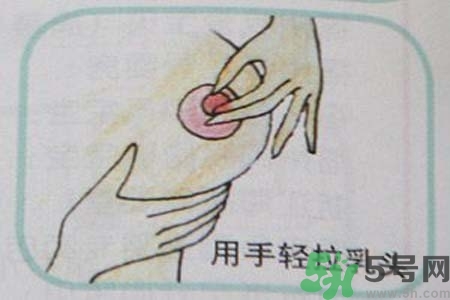 乳頭內(nèi)陷怎么辦？乳頭內(nèi)陷的癥狀有哪些？