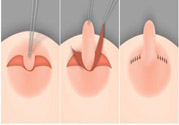 乳頭內(nèi)陷怎么辦？乳頭內(nèi)陷的癥狀有哪些？