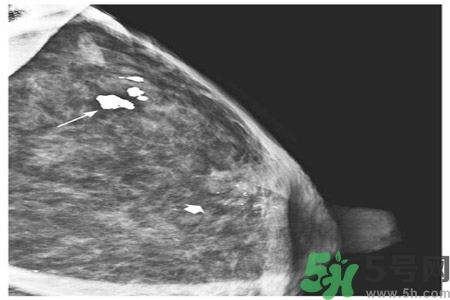 乳腺增生鈣化是什么？乳腺鈣化的癥狀有哪些？