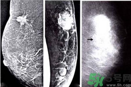 乳腺增生鈣化是什么？乳腺鈣化的癥狀有哪些？