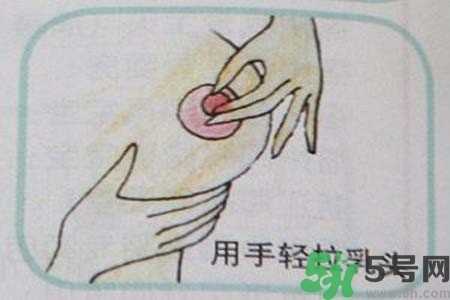 乳頭內(nèi)陷怎么矯正？乳頭內(nèi)陷矯正方法是什么？