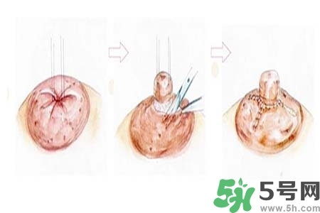 乳頭內(nèi)陷怎么矯正？乳頭內(nèi)陷矯正方法是什么？