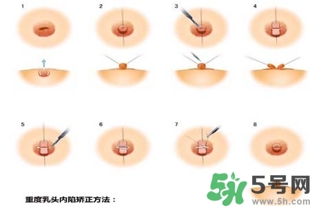 乳頭內(nèi)陷怎么矯正？乳頭內(nèi)陷矯正方法是什么？