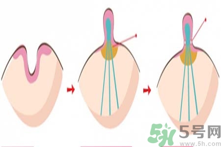 乳頭內(nèi)陷矯正需注意什么？乳頭內(nèi)陷如何預(yù)防？