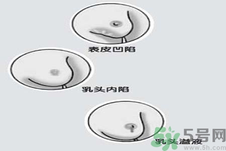 乳頭內(nèi)陷矯正需注意什么？乳頭內(nèi)陷如何預(yù)防？