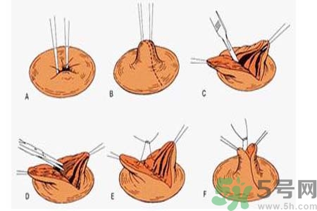 乳頭內(nèi)陷可以拔罐嗎？乳頭內(nèi)陷需要手術(shù)治療嗎？