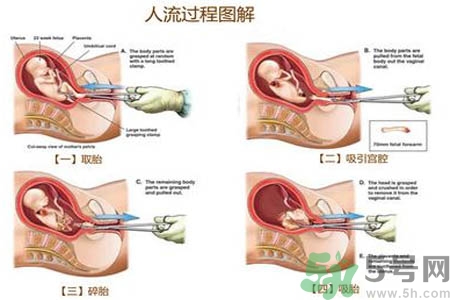 人工流產(chǎn)后多久可以再次懷孕？流產(chǎn)后需要注意什么？