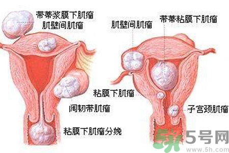 ?子宮移位怎么治療？子宮移位能懷孕嗎？