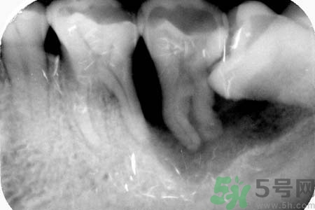 拔智齒一顆多少錢？拔除智齒收費(fèi)多少？