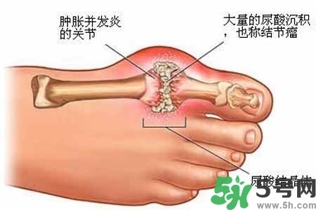 引發(fā)痛風(fēng)的原因是什么？痛風(fēng)病人飲食需注意什么好？