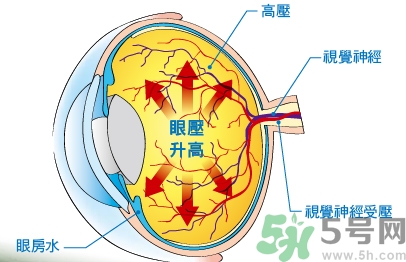 青光眼可以治愈嗎？青光眼怎樣治療？