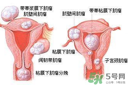 子宮小會(huì)影響生育嗎？子宮小會(huì)導(dǎo)致不孕嗎？