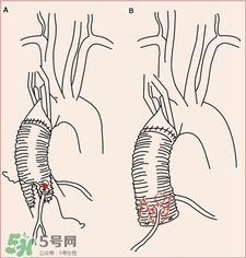 人造血管可以用多久?人造血管的護理